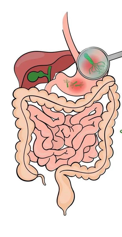 怎么得卡式幽门螺杆菌健康科普--幽门螺杆菌常识_https://www.jmylbn.com_新闻资讯_第1张